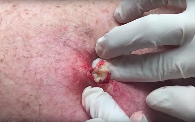 Dr. Pimple Popper krijgt een eigen tv-programma: hier haar vijf goorste video’s