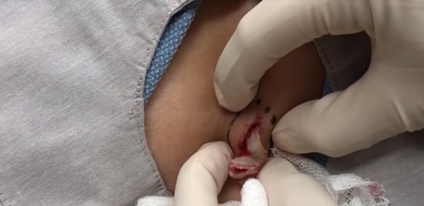 Gatverdamme, Dr. Pimple Popper is terug! Hier haar 9 smerigste puistenvideo’s